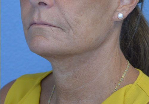 Face and Neck Lift