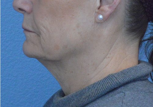 Face and Neck Lift