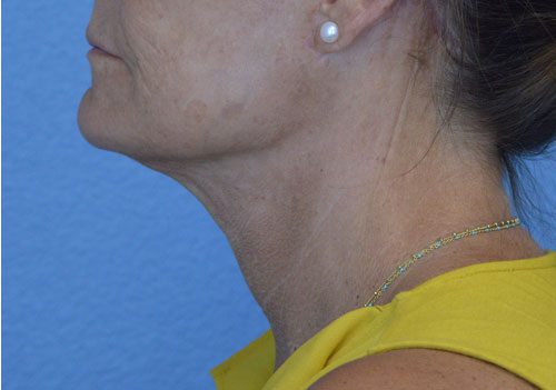 Face and Neck Lift