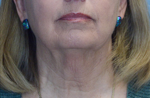 Face and Neck Lift