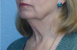 Face and Neck Lift