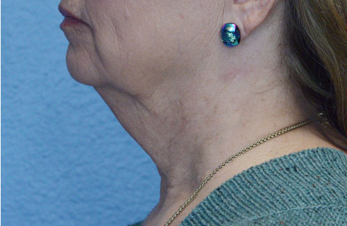 Face and Neck Lift