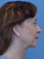 Kybella