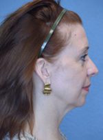 Kybella