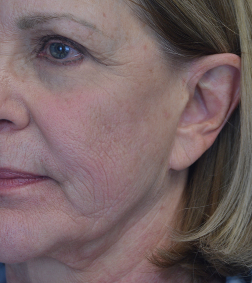 Laser Treament Results Reno
