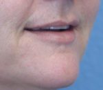 Lip Augmentation