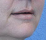 Lip Augmentation