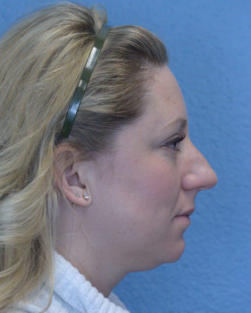 Rhinoplasty