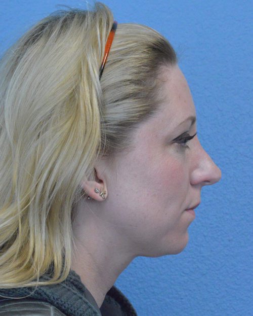 Rhinoplasty