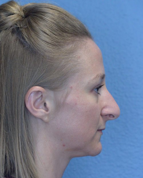 Rhinoplasty