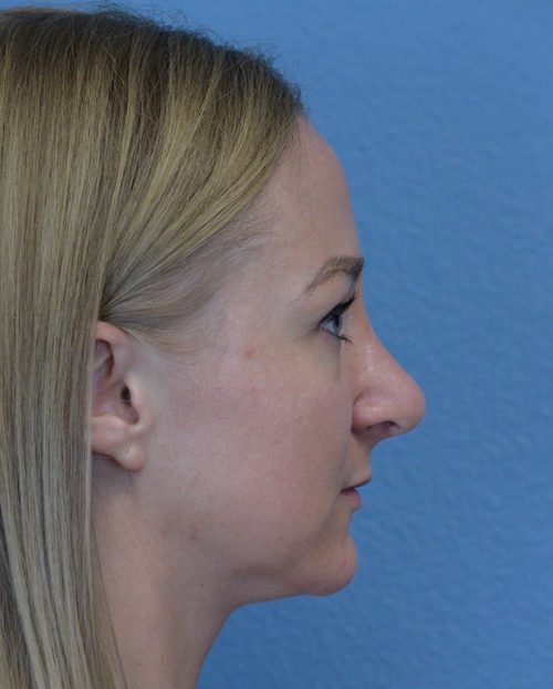 Rhinoplasty