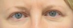 Blepharoplasty