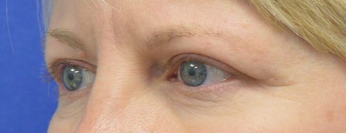 Blepharoplasty