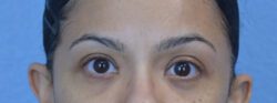 Blepharoplasty