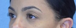 Blepharoplasty