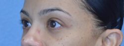 Blepharoplasty