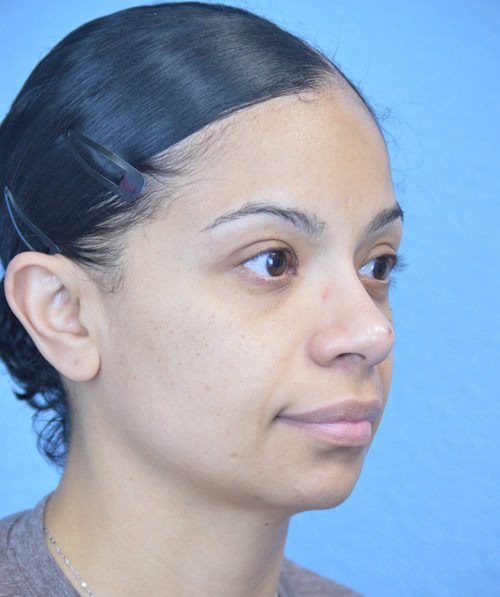 Blepharoplasty