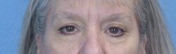 Blepharoplasty