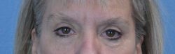 Blepharoplasty