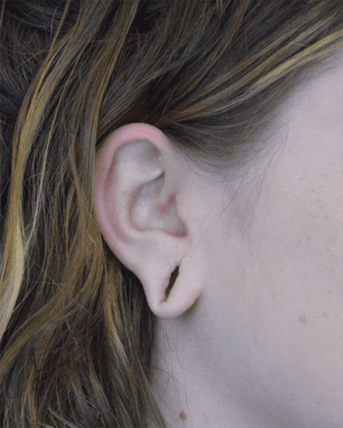 Ear Lobe Repair