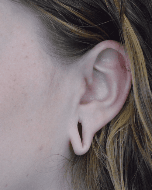 Ear Lobe Repair