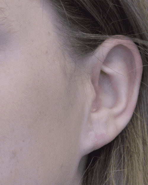 Ear Lobe Repair