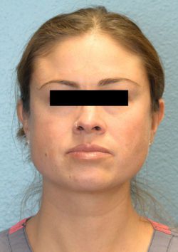 Cheek Augmentation