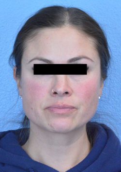 Cheek Augmentation