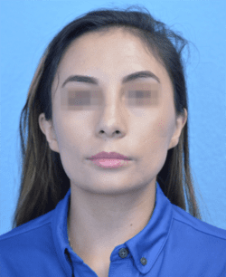 Rhinoplasty