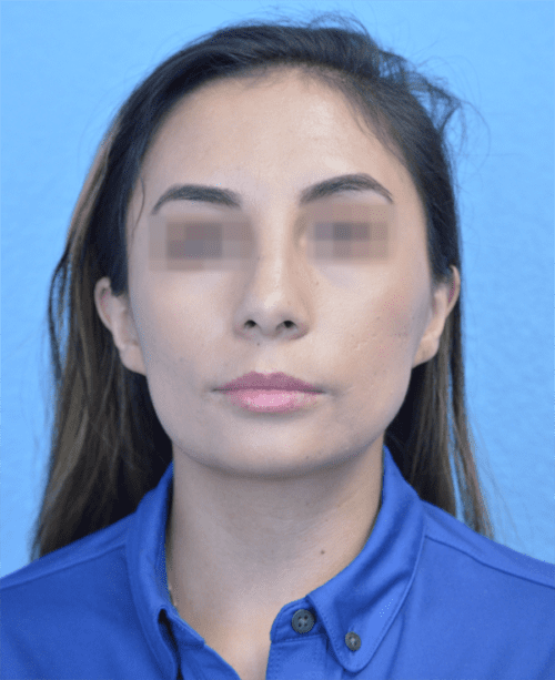 Rhinoplasty