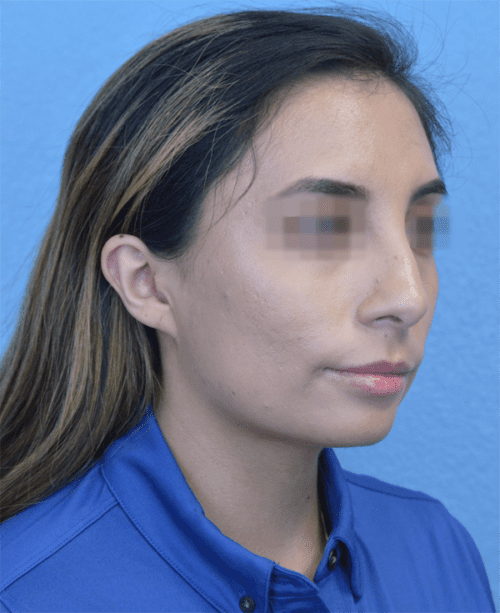 Rhinoplasty