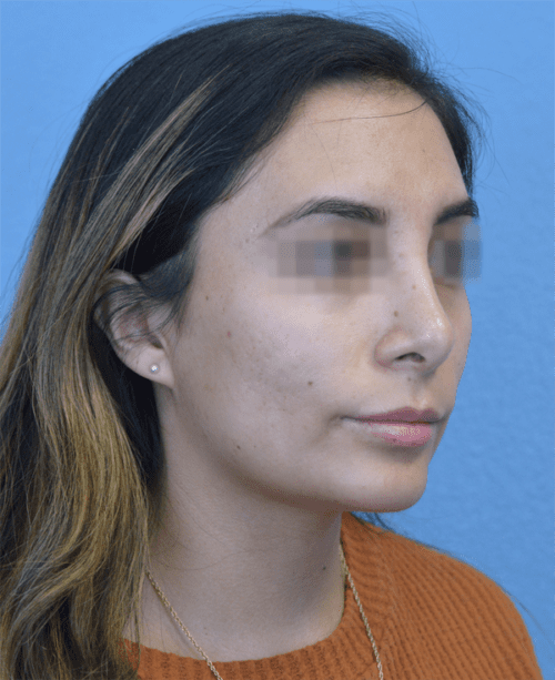 Rhinoplasty