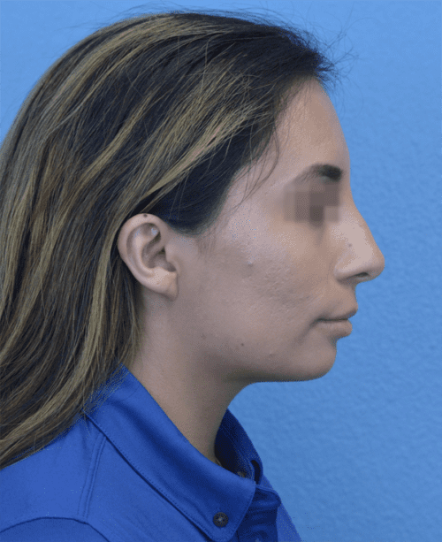 Rhinoplasty