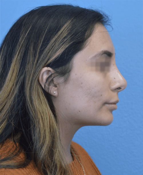 Rhinoplasty