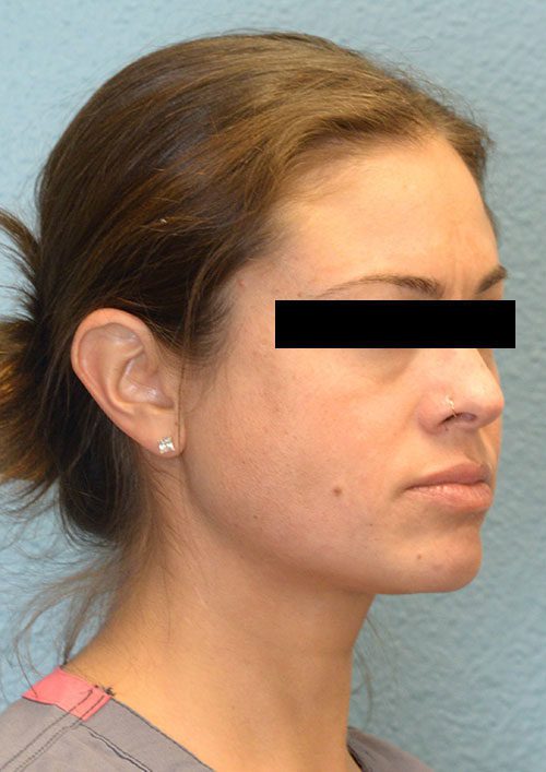 Cheek Augmentation