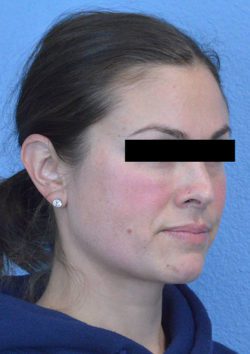 Cheek Augmentation