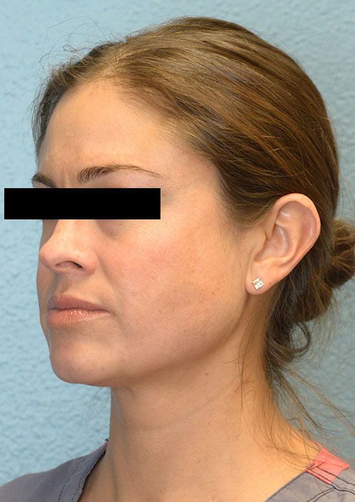 Cheek Augmentation