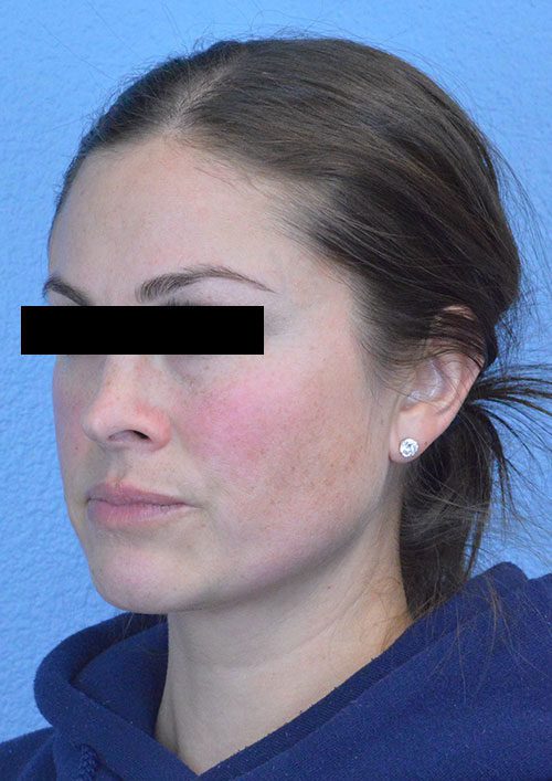 Cheek Augmentation