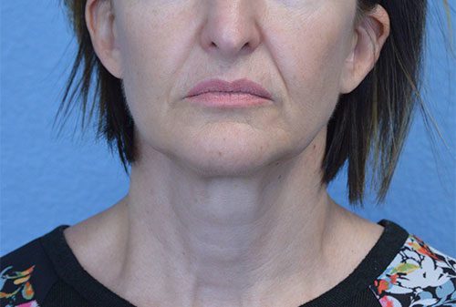 Mini Face and Neck Lift