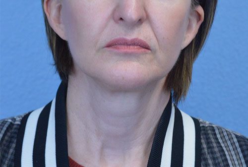 Mini Face and Neck Lift