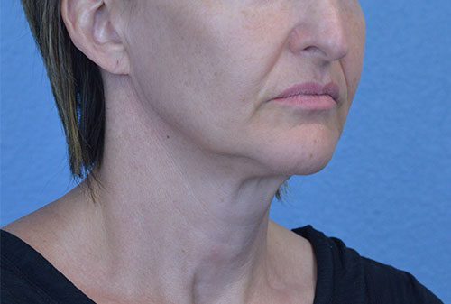 Mini Face and Neck Lift
