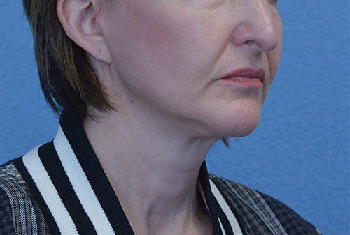 Mini Face and Neck Lift