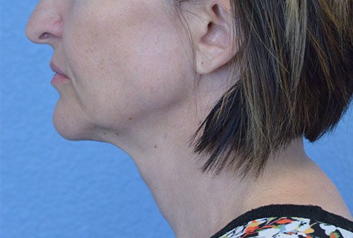 Mini Face and Neck Lift