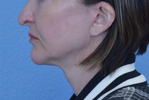 Mini Face and Neck Lift