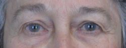 Blepharoplasty