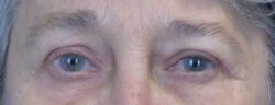 Blepharoplasty