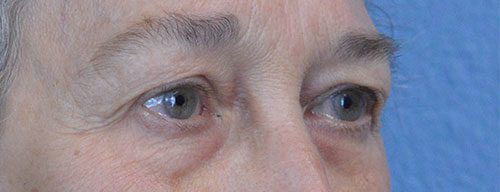 Blepharoplasty