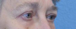 Blepharoplasty