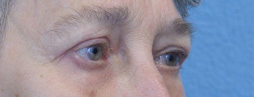 Blepharoplasty