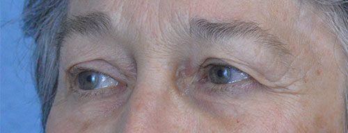 Blepharoplasty